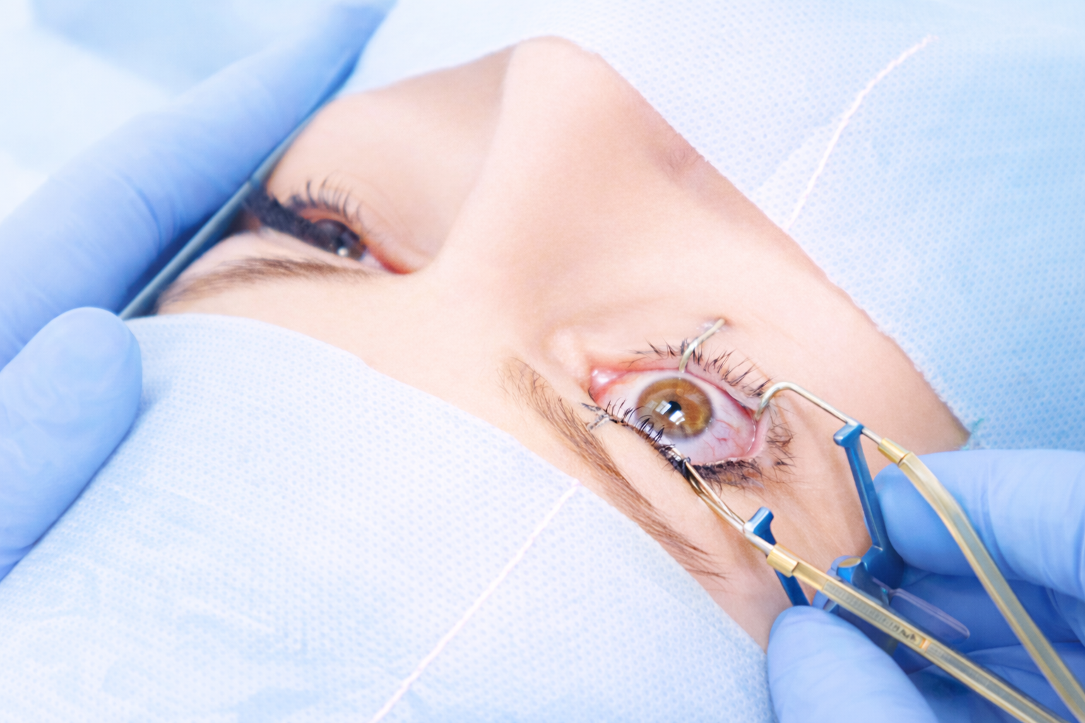 Снятие швов с роговицы (конъюнктивы)